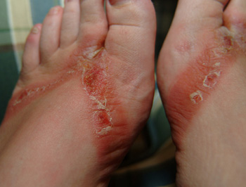 Severe Blisters