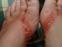 Blisters caused by toxic China made flip-flops